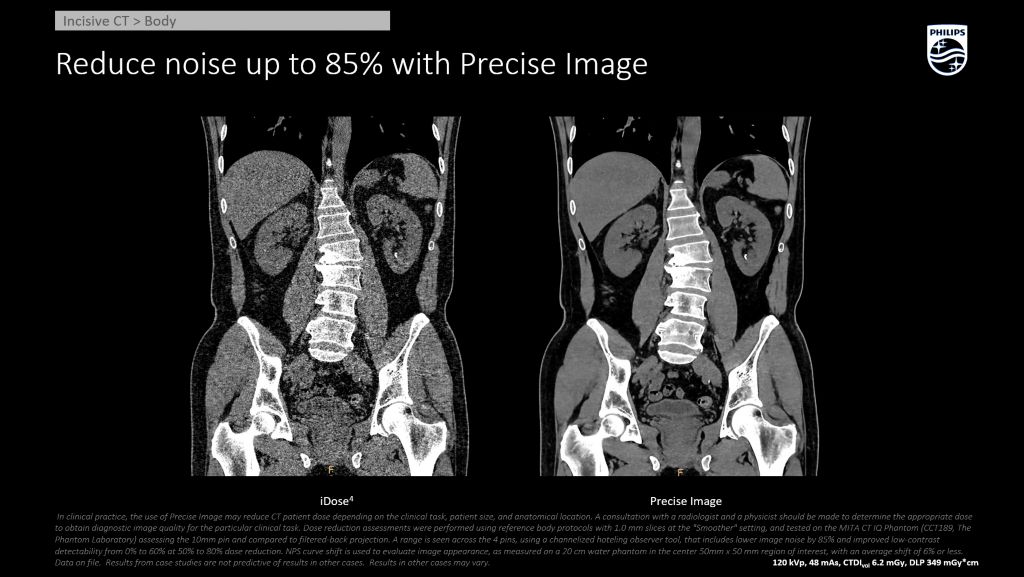 Incisive CT Body - Kidney Stone Precise Image