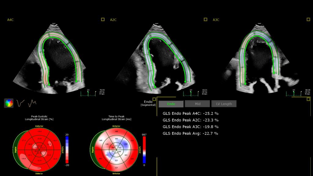 VM 11.0 Transcend Affiniti CVx Autostrain app clinical image Ultrasound