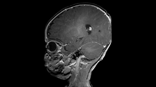 3D T1w TFE plus gado (neonate)