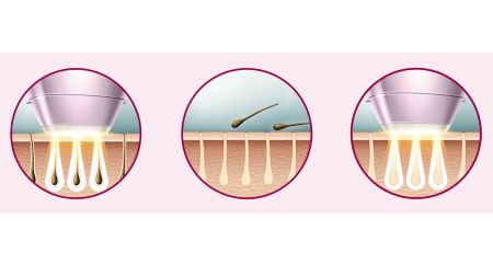 Expert IPL technology at-home, developed with dermatologists