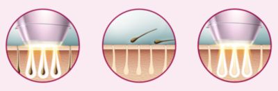 تقنية IPL المتطورة للاستخدام في المنزل، تم تطويرها بالتعاون مع أطباء الأمراض الجلدية