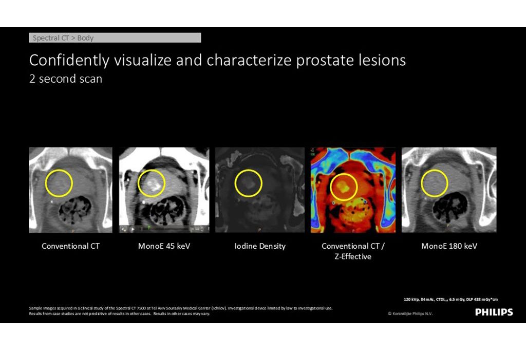 Spectral CT – Body