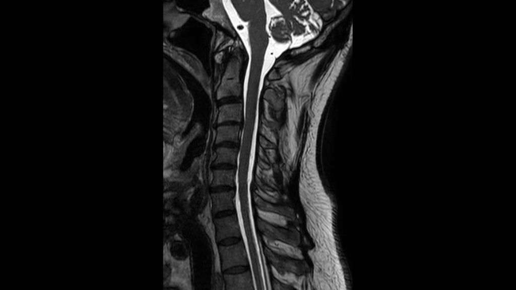 Sagittal 3D SpineVIEW T2w TSE