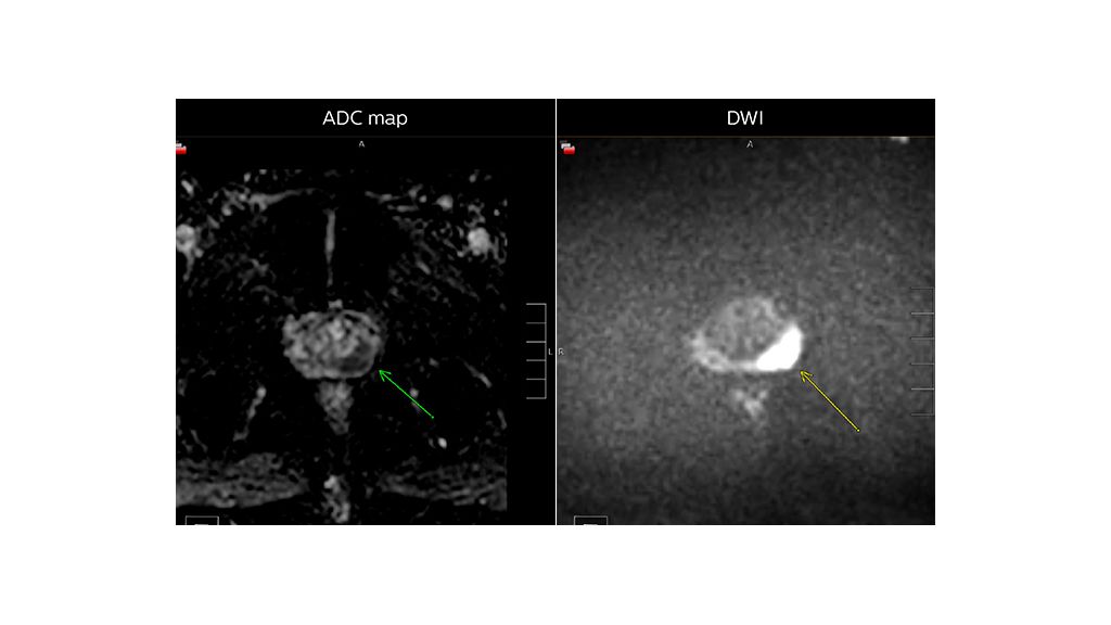 Dr. Steiner Article MR adc vs dwi