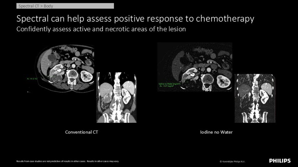 Spectral CT – Body