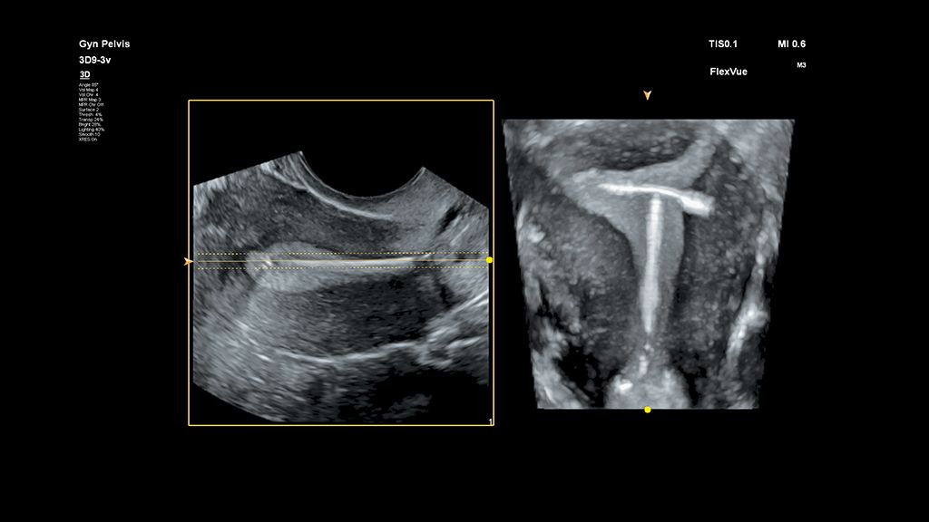 Uterine image with IUD using FlexVue and 3D9-3v transducer