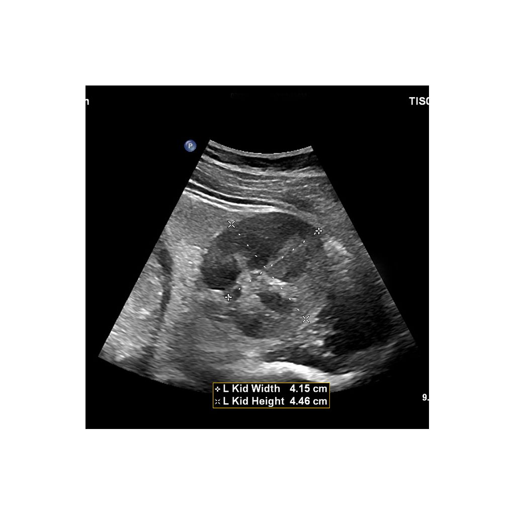 Clinical image using EPIQ Elite and C5-1 transducer to show kidney width and height 