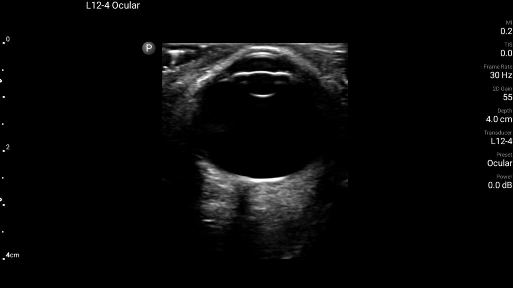 Ocular scan using L12-4 transducer on Lumify.