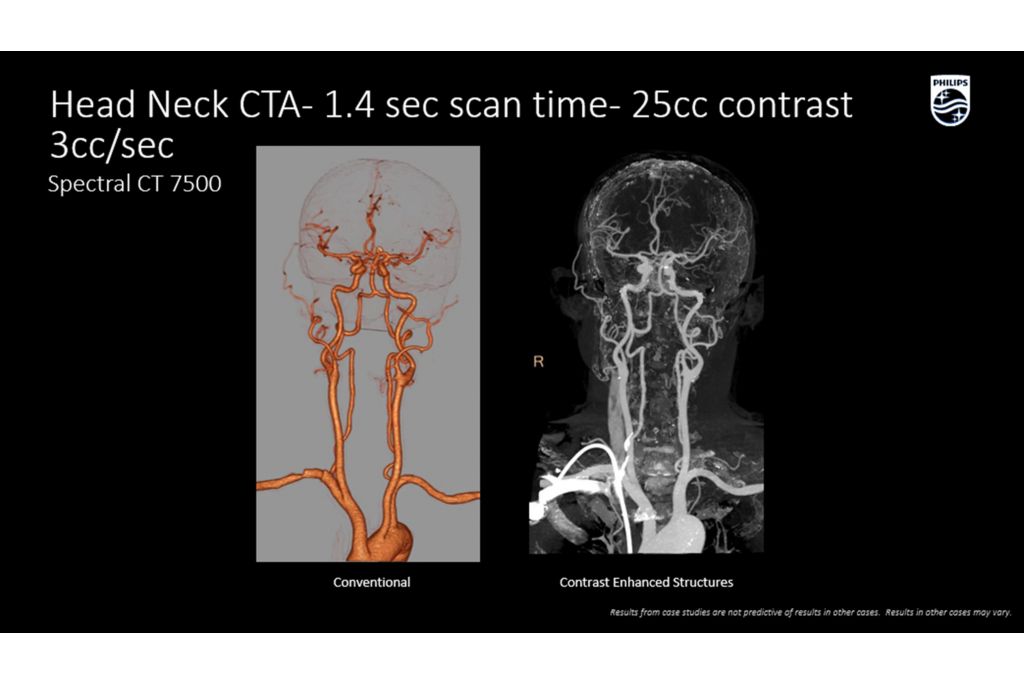 CT Spectral 7500 Head Neck CTA