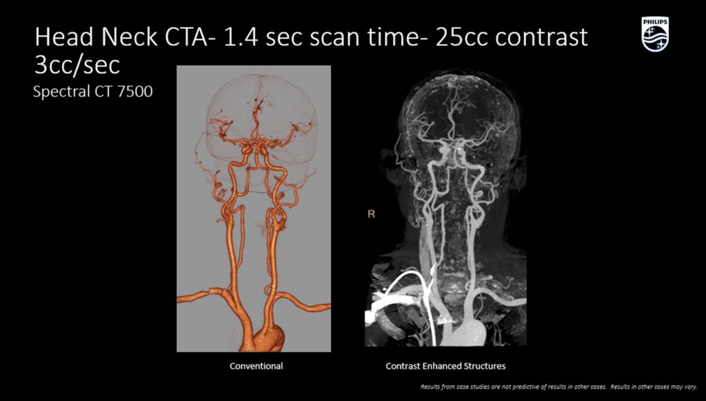 CT Spectral 7500 Head Neck CTA