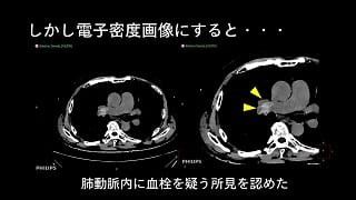 case 74
単純画像から肺塞栓症を見つける