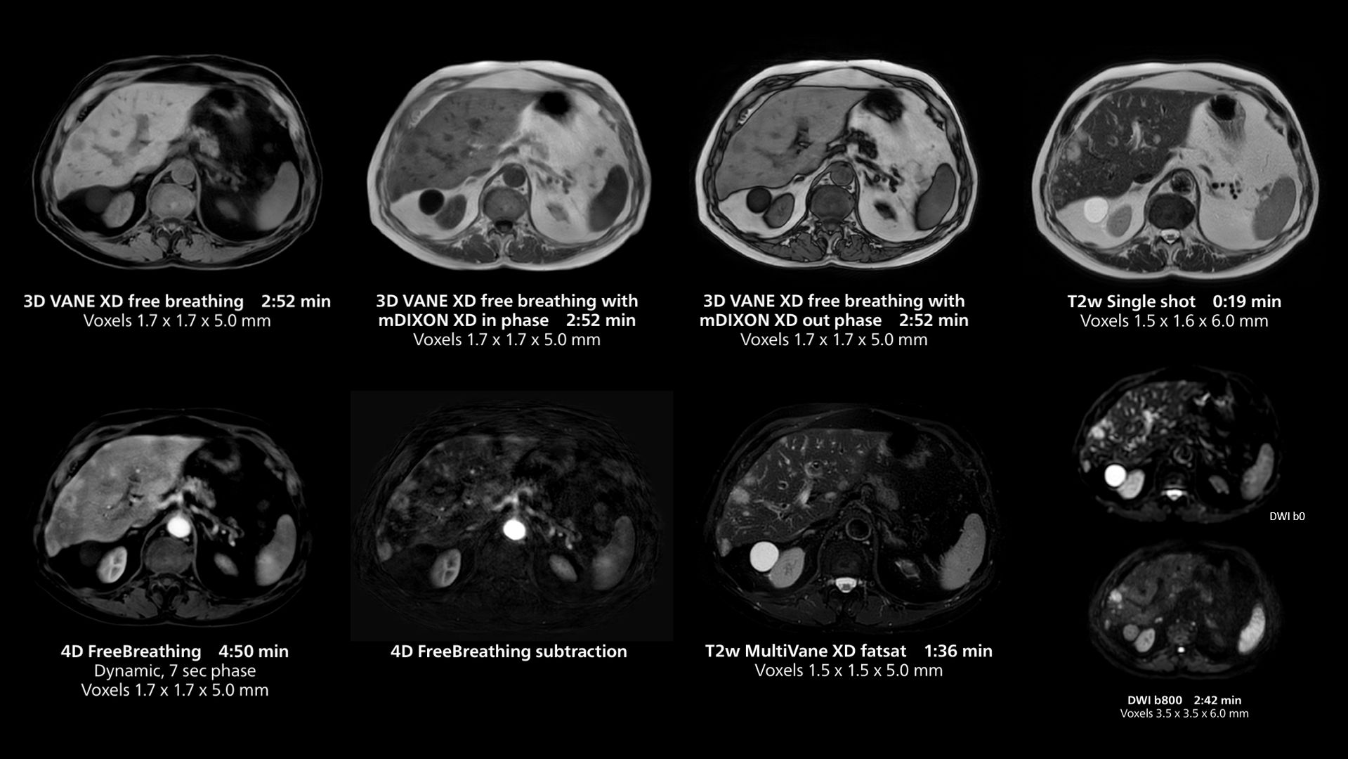 Liver imaging using MR 5300