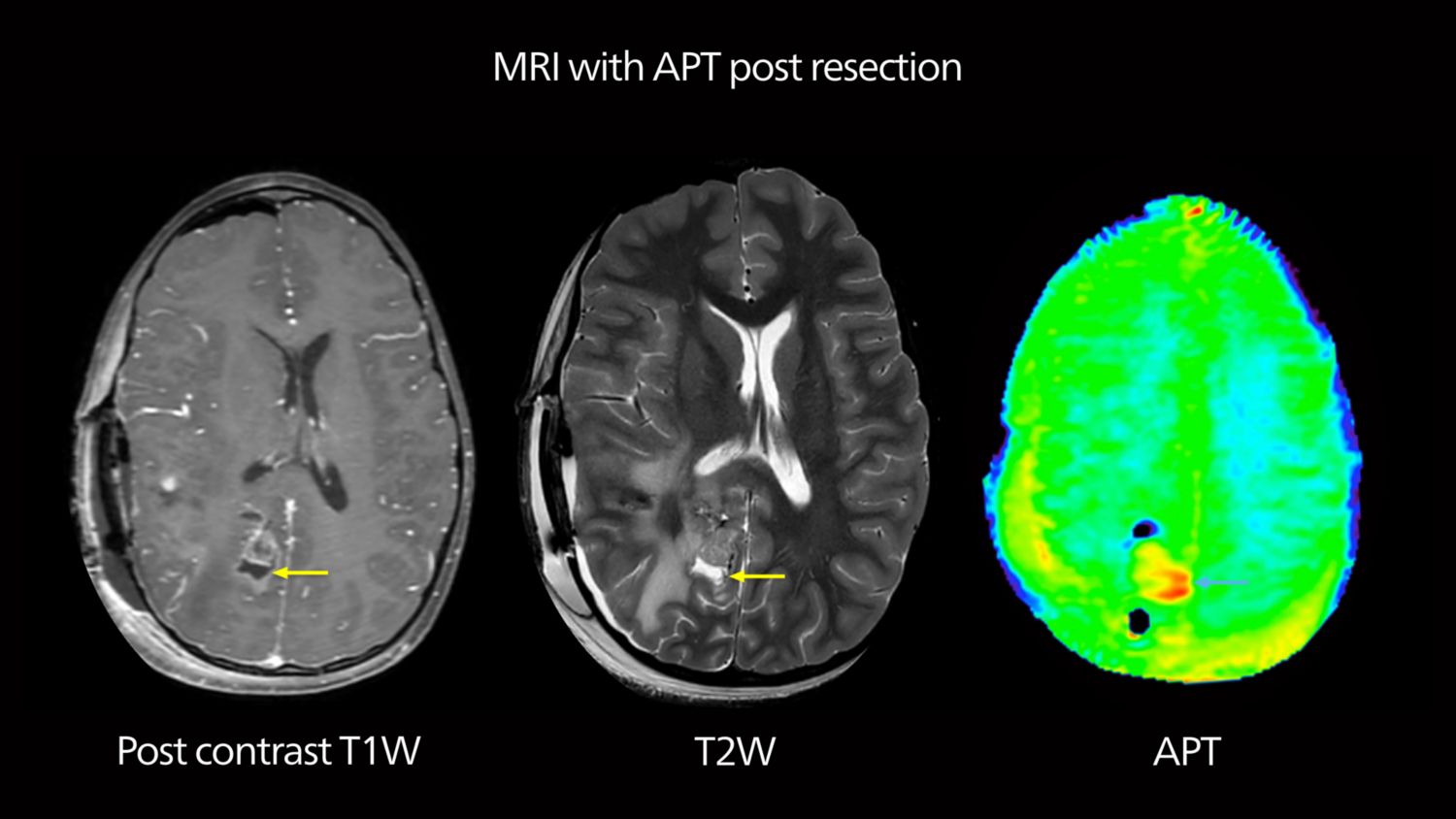 Post-op brain APT MRI 