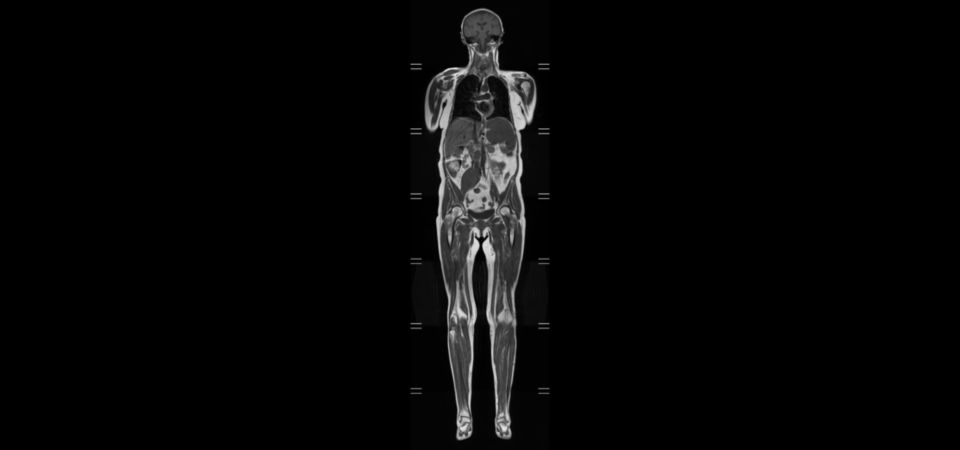 Whole Body imaging - T1w TSE