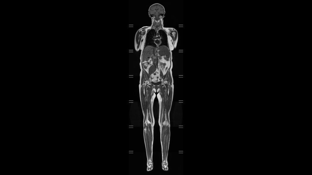 Whole Body imaging - T1w TSE