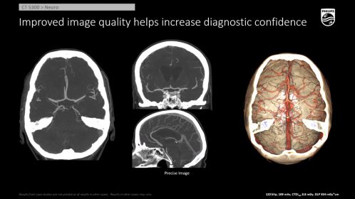 CT 5300 Neuro CTA