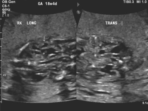 C5-1 transducer coronal and transverse image of the right multicystic renal abnormality