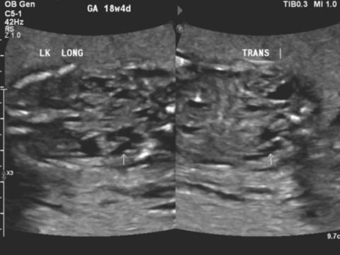 Figures 1 C5-1 transducer coronal and transverse image of the left and right multicystic renal abnormality