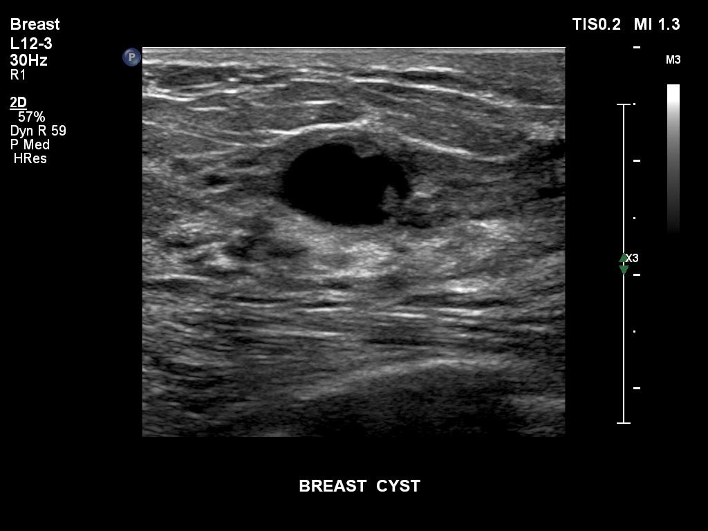 Breast cyst