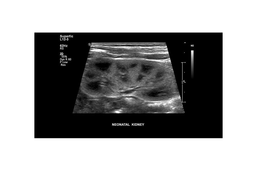 Philips EPIQ 7 ultrasound clinical image of a neonatal kidney