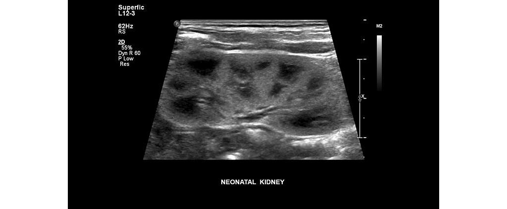 Philips EPIQ 7 ultrasound clinical image of a neonatal kidney