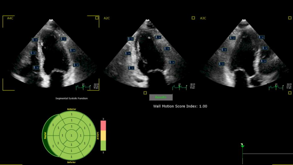 VM 11.0 Transcend Affiniti CVx X5-1 SWM app clinical image Ultrasound