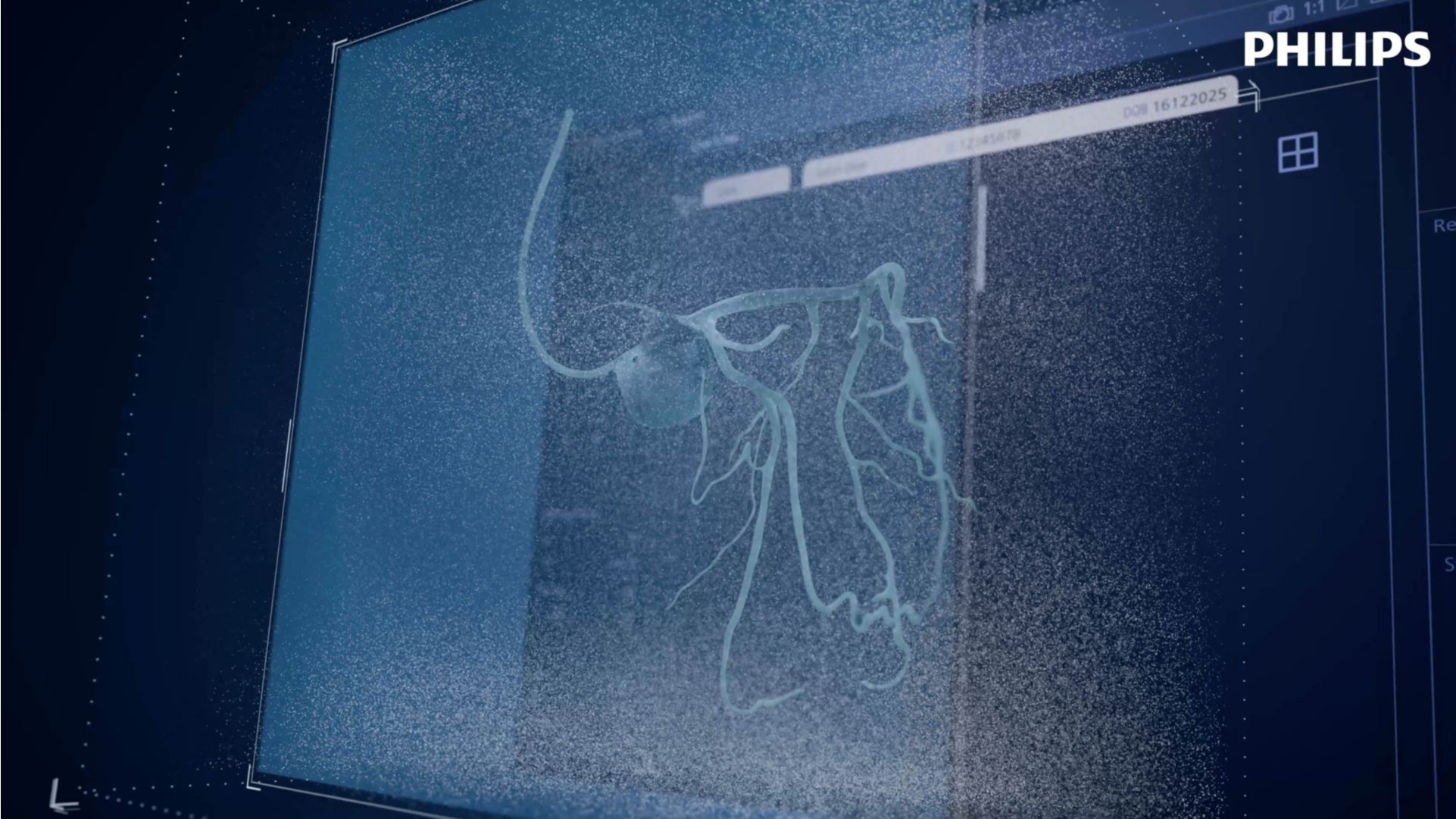 SmartIQ next generation of coronary imaging