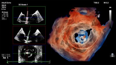 Live 3D TEE clinical image of mitral valve shown using TrueVue Glass feature.
