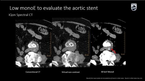 IQon Spectral low monoE to evaluate the aortic stent