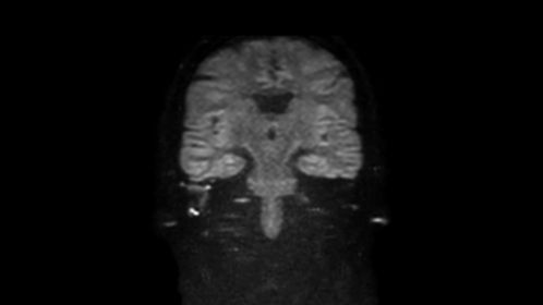 Coronal DWI TSE (b1000)