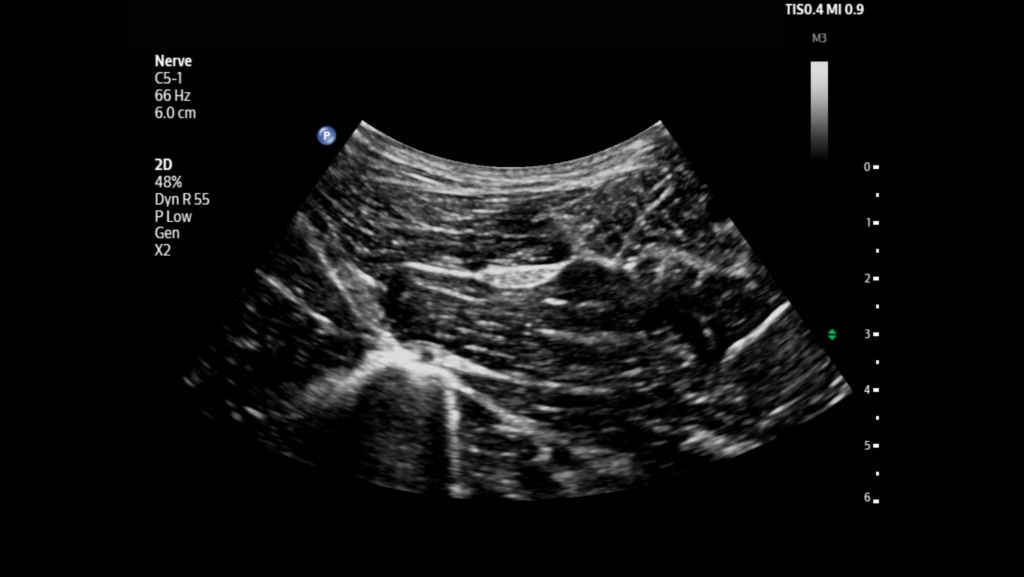 Sciatic nerve shown using C5-1 transducer.
