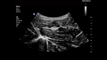 Sciatic nerve shown using C5-1 transducer.