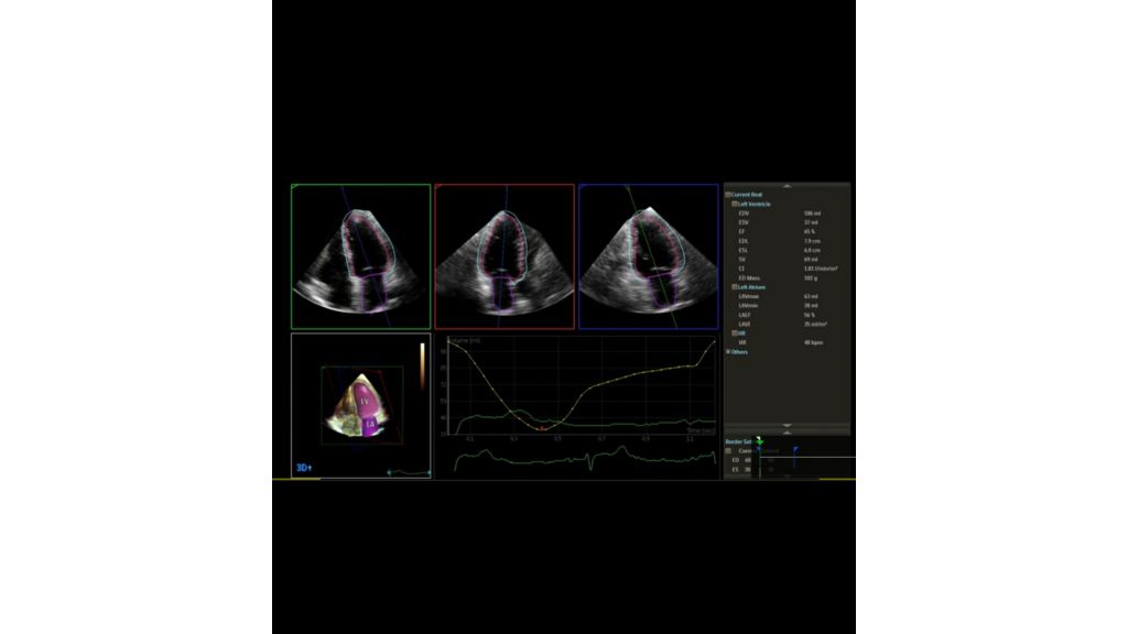 VM 11.0 Transcend Affiniti CVx X5-1 dynamic heart model DHM app clinical image