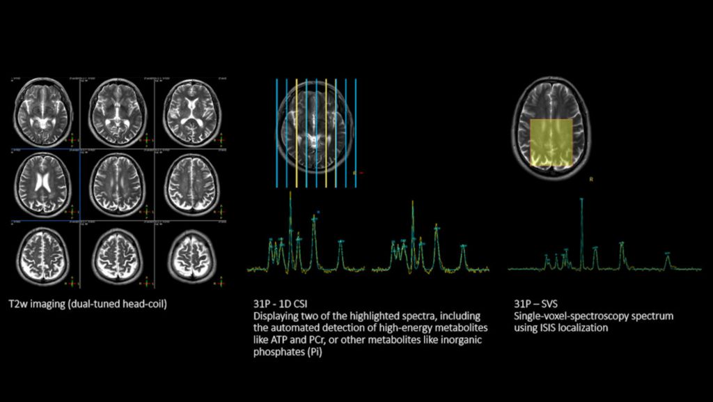 Multi Nuclei Brain exam 1H and 31P
