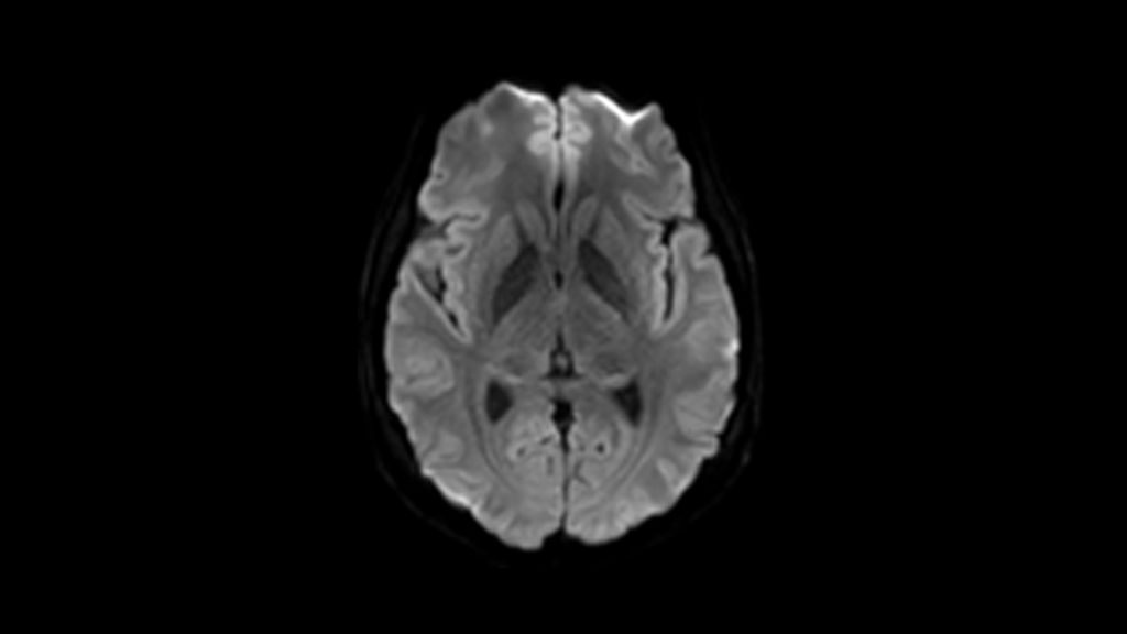 DWI clinical image of the brain