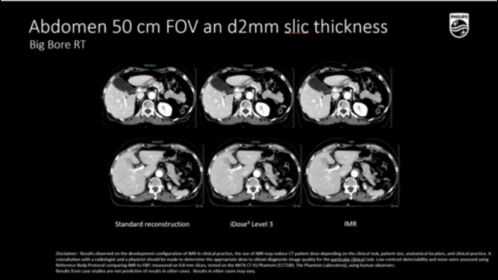 BBRT Abdomen 50 cm FOV and 2mm Slice thickness