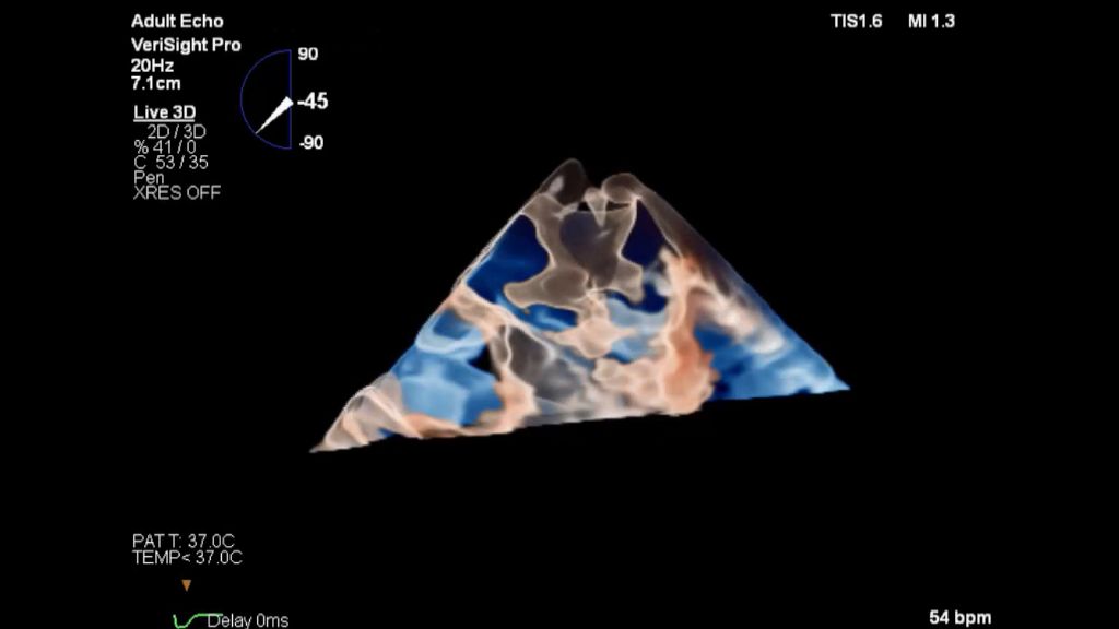 3D imaging mode
Image courtesy: Dr. Mohamad Alkhouli, Mayo Clinic