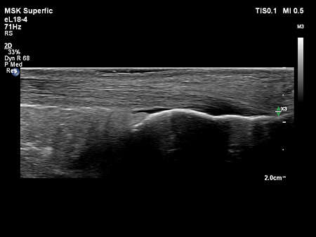 eL18-4 MSK Achilles Tendon