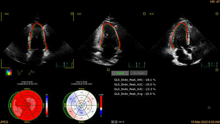 Автоматизация для воспроизводимости количественного анализа сердца в режиме 2D