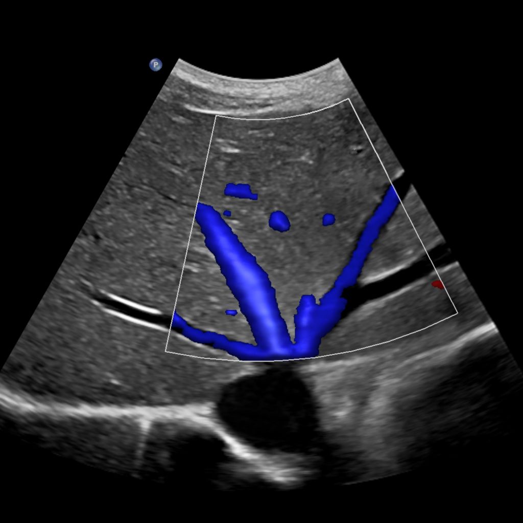 Ultrasound scan showing flow viewer tool