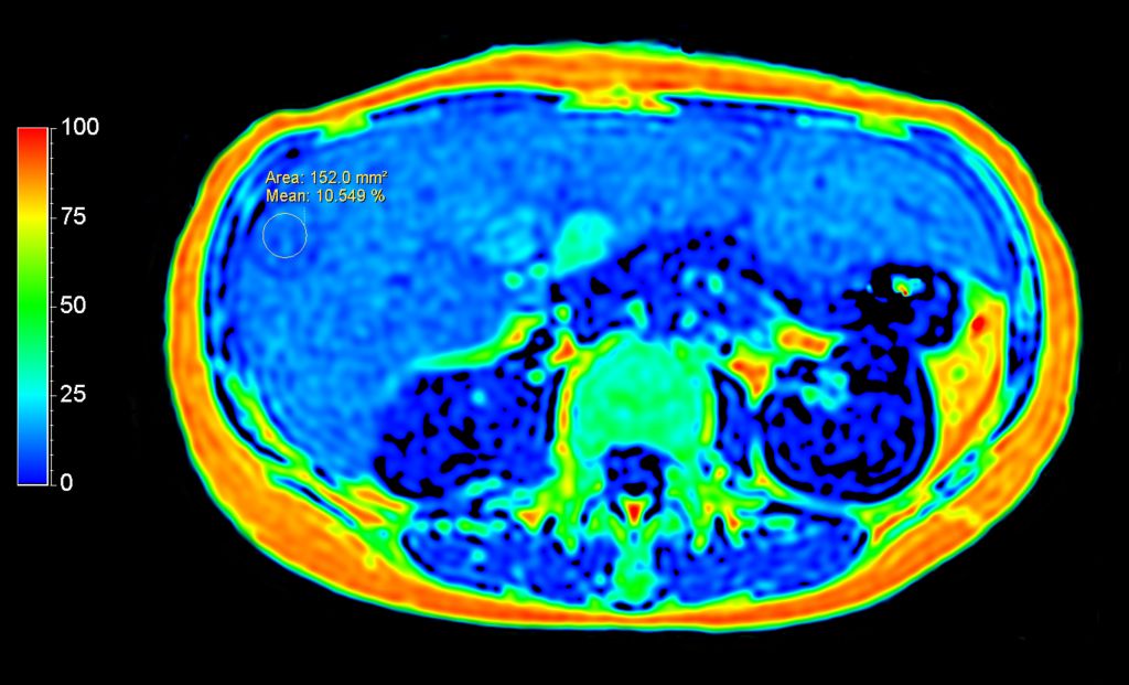 Axial mDIXON Quant (fat fraction)