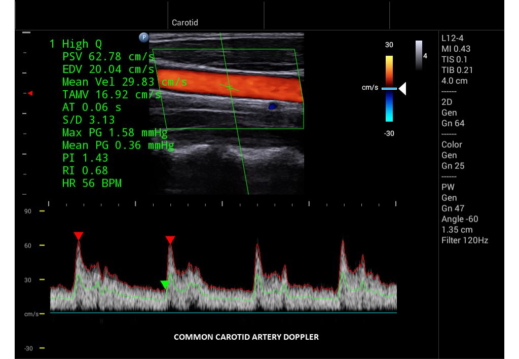 InnoSight clinical image common carotid artery Doppler