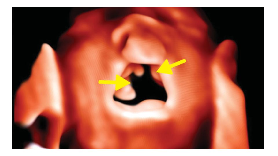 3D surface rendered oropalatal (SROP) view with an open mouth using the V6-2 transducer with TrueVue technology.