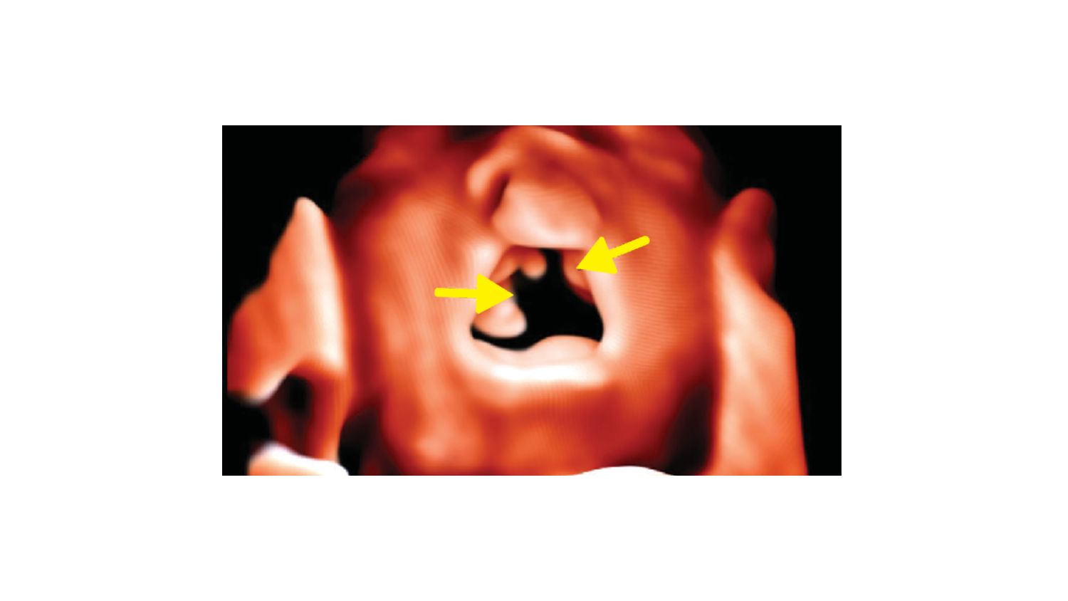 3D surface rendered oropalatal (SROP) view with an open mouth using the V6-2 transducer with TrueVue technology.