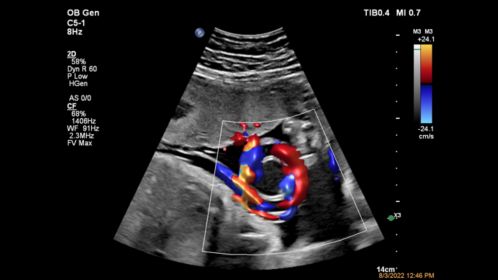 C5-1 Umbilical Cord Color Flow with Flow Viewer
