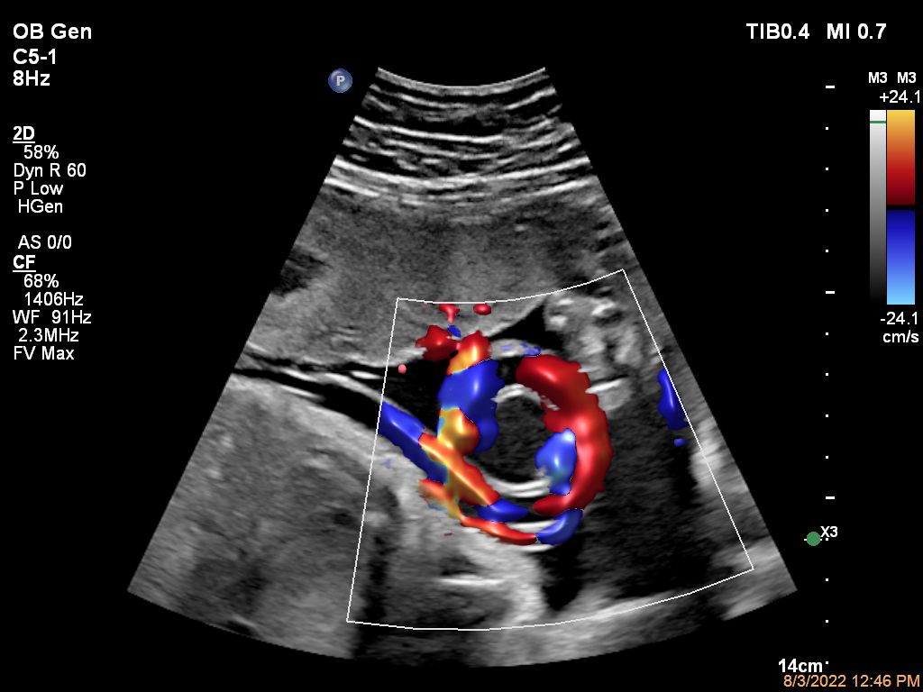 Umbilical Cord Color Flow with Flow Viewer