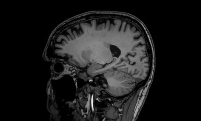 clinical brain image of a person diagnosed with Alzheimer's disease