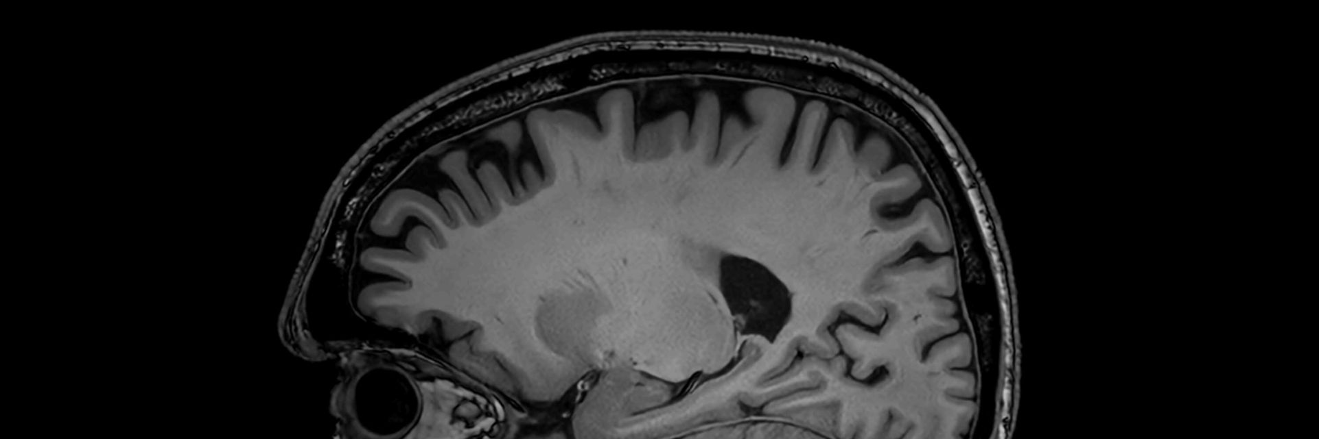 Brain MRI showing the brain of a patient diagnosed with Alzheimer’s disease 