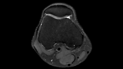 3D MSK VIEW - PDw SPAIR (axial reformat)