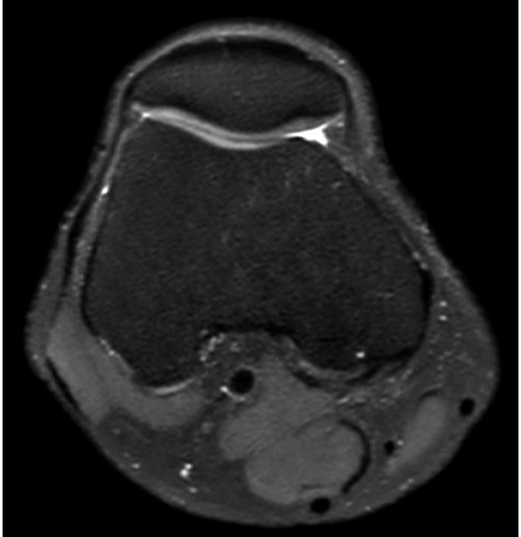 3D MSK VIEW - PDw SPAIR (axial reformat)